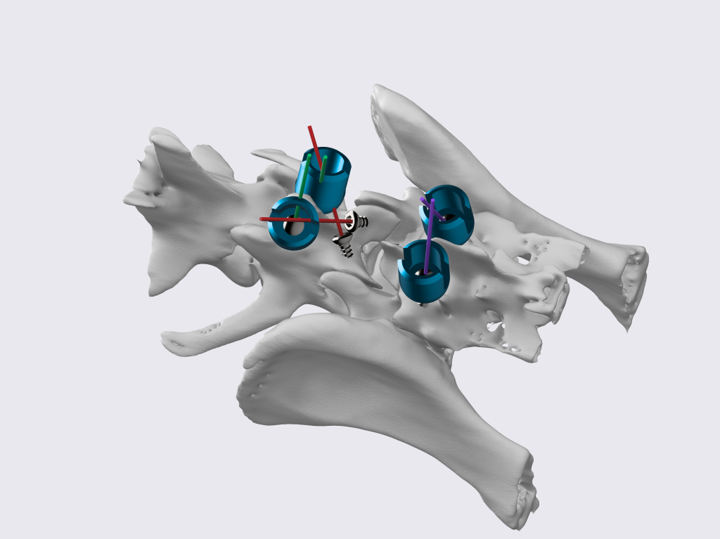 NDSR Neurology Team Uses Novel Implants For Spinal Care
