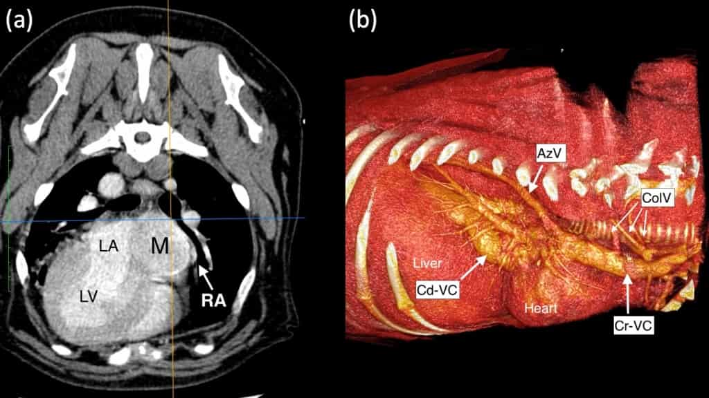 Minimally Invasive Cardiac Surgery Ensures Swift Recovery For Stanley